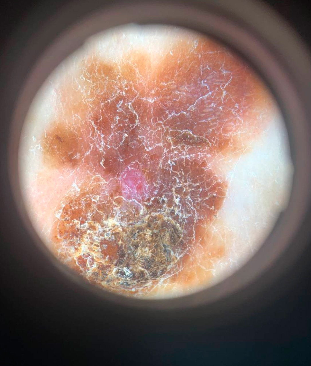 Melanoscope