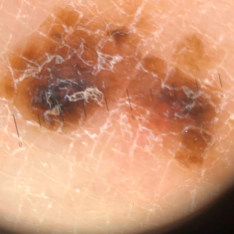 Melanoscope